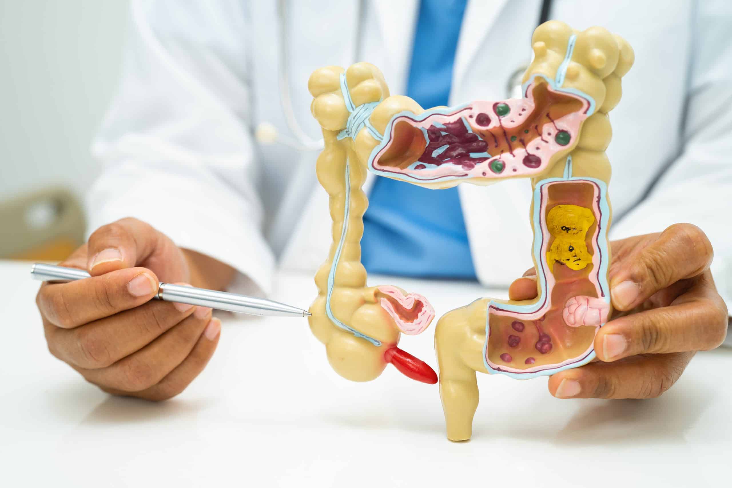 CÁNCER DE COLON: UNA ENFERMEDAD SILENCIOSA PERO PREVENIBLE